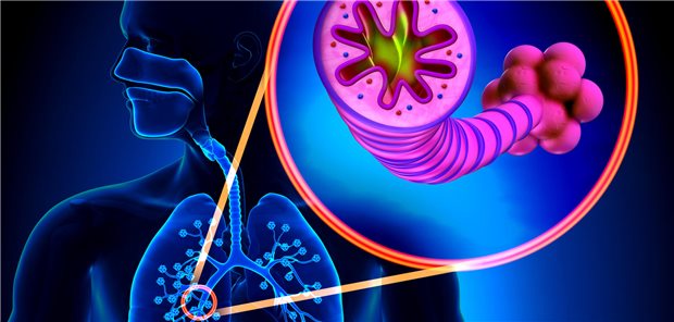 Dreidimensionale Darstellung der Bronchien eines Patienten mit Chronisch obstruktiver Lungenerkrankung (COPD).