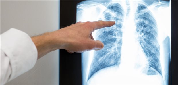 Unsere Beiträge vom Pneumologie-Kongress im Überblick Lunge im Fokus: Beim DGP-Kongress wurden über neue Erkenntnisse in der Pneumologie informiert.