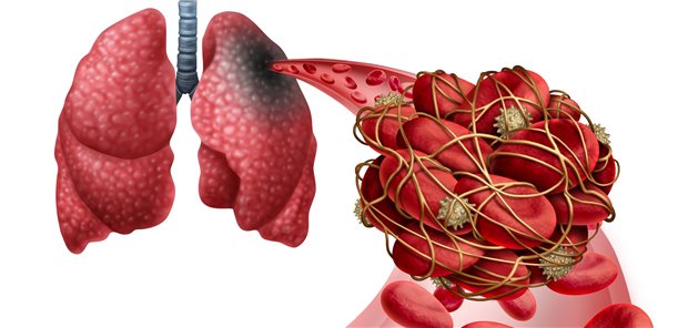 Lungenembolie: Nach einer Infektion mit SARS-CoV-2 ist das Risiko für venöse Thromboembolien offenbar längerfristig erhöht, und zwar für tiefe Venenthrombosen bis zu drei Monate und für Lungenembolien bis zu sechs Monate.