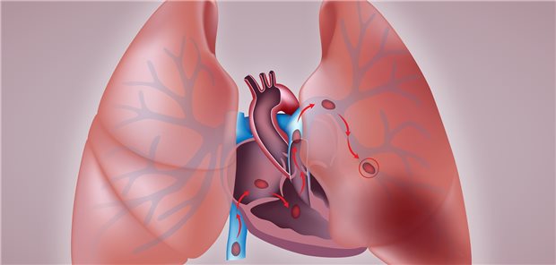 Hoher Anteil von Gerinnungsstörungen bei COVID-19 Lungenembolie: Thromboembolische Ereignisse sind häufige Todesursachen bei COVID-19. Alila Medical Media / stock.adobe.com