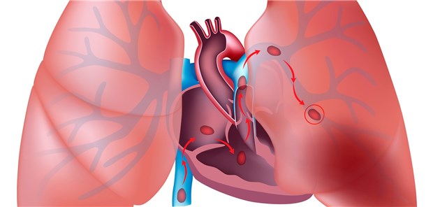 Lungenembolie: Zur besseren Prognose scheint die systemische Lyse beigetragen zu haben.