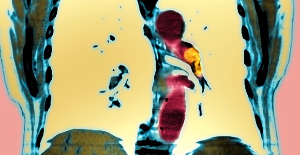Nicht reflexhaft zur CT! Lungenembolie dargestellt in einer eingefärbten koronaren CT-Aufnahme. Ein großer Embolus (orange) befindet sich in der linken pulmonalen Hauptarterie (im Bild rechts).