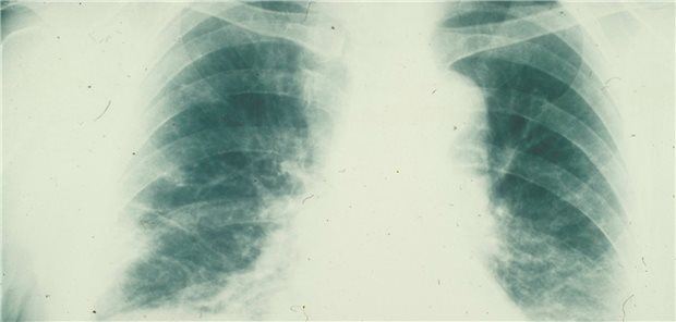 Lungenfibrose bei Mischkollagenose.