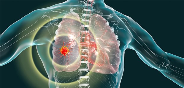 Lungenkarzinom: Früherkennung könnte die lungenkrebsspezifische Mortalität senken.