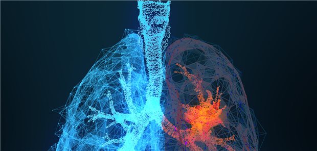 Lungenkrebs: Eine neue zielgerichtete Therapieoption verbessert die Prognose von Patienten mit fortgeschrittenem NSCLC deutlich.