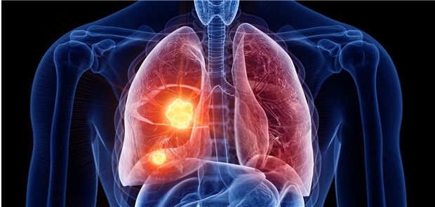 Lungenkrebs: Mit der Kombination von PD-1- und CTLA4-Inhibitor verbessern sich die Therapiechancen bei NSCLC-Patienten.
