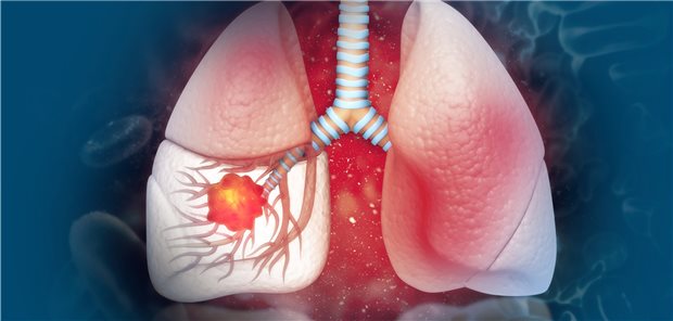 Lungenkrebs: Mit einem Niedrigdosis-CT-Screening werden bei langjährigen Rauchern Karzinome immer häufiger in frühem und immer seltener in fortgeschrittenem Stadium entdeckt.