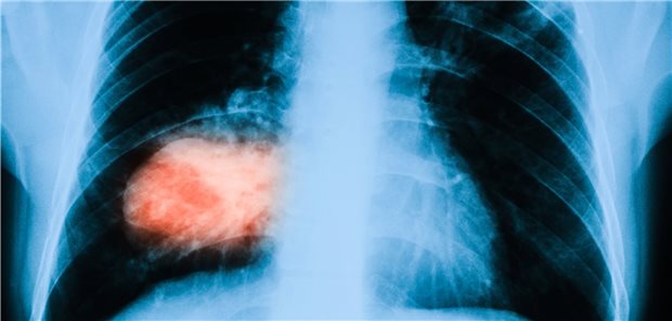Lungenkrebs: Nicht immer trifft es nur Raucher. COPD-Patienten scheinen per se ein hohes Risiko zu haben.