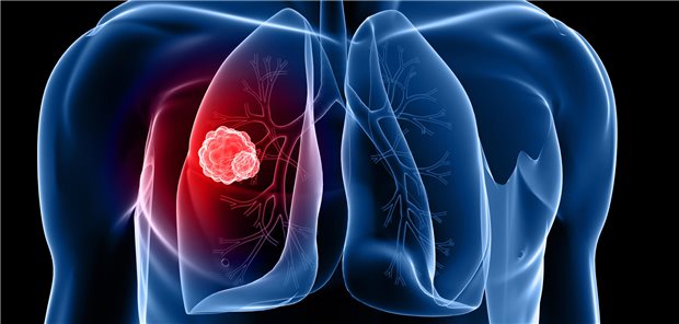 Lungenkrebs: Was bringt ein opportunistisches Low-Dose-CT-Screening?