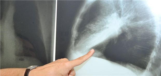 Ein Arzt zeigt auf ein Rötgenbild der Lunge mit Krebs