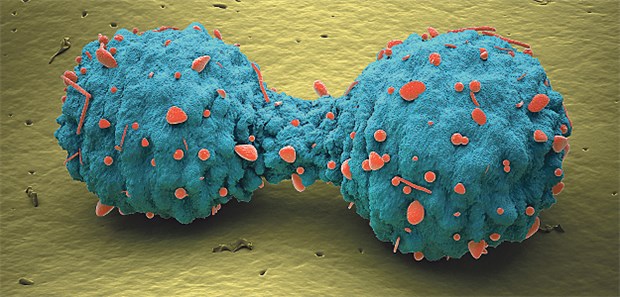 Kombination von Immuntherapeutika bringt Vorteile Lungenkrebszellen; beim fortgeschrittenen NSCLC haben sich die Therapiechancen verbessert.