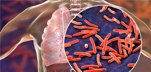 Lungentuberkulose: Ein Viertel der Weltbevölkerung ist nach Schätzungen mit Mycobacterium tuberculosis latent infiziert.