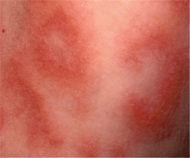Mehr Embolien bei Autoimmunstörungen Lupus erythematodes: Er und andere Autoimmunerkrankungen erhöhen das Embolie-Risiko.
