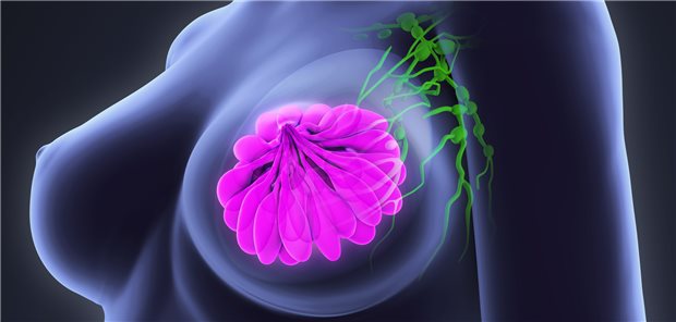 Computerdarstellung: Weibliche Brust und Lymphknoten in der Axilla.