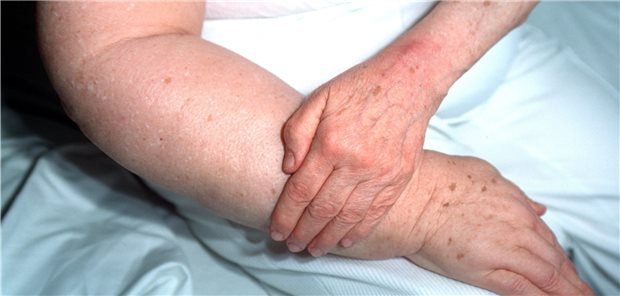 Lymphödem: Zur Symptomlinderung könnten sich einem vorläufigen IQWiG-Bericht zufolge die Kompressionstherapie, das Heimprogramm oder der vaskularisierte Lymphknotentransfer eignen.