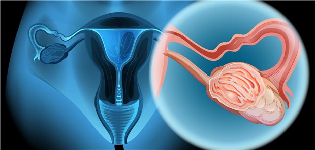 MIRV zeigte in einer Phase-III-Studie signifikante Verbesserungen für Frauen mit fortgeschrittenem Ovarialkarzinom – sowohl beim progressionsfreien Überleben als auch beim Gesamtüberleben im Vergleich zu einer weiteren Chemotherapielinie.