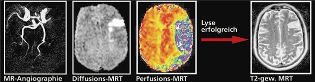Bei Diabetes besteht hohe Schlaganfallgefahr, und nach einer TIA wird es brenzlig MR-Angiografie und Spezial-MRT bei Schlaganfall. Irreversibel geschädigtes Areal ist weiß im Diffusions-MRT (mitte links). Viel größer sind die potenziell gefährdeten Areale (blau im Perfusions-MRT). Eine Lyse hat diese Gebiete gerettet.