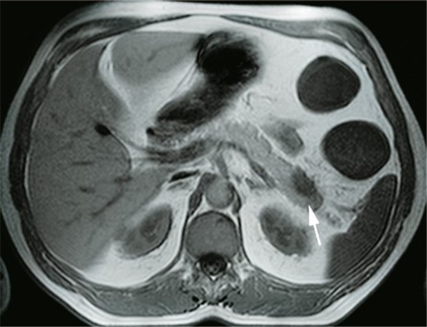 MRE: Raumforderung (Pfeil) im Pankreasschwanz eines Morbus-Crohn-Kranken. Spätere Diagnose: Pankreas-Ca.