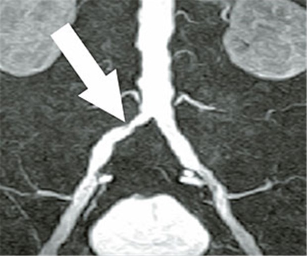 Gehtraining bei proximaler PAVK wirksamer als Stents MRT-Angiografie mit Stenose der rechten Beckenarterie.