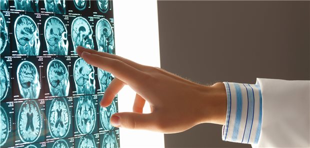 MRT-Aufnahme: Bei Schulkindern geben Auffälligkeiten im Hirn-MRT oft Anlass zur Sorge – meist stecken jedoch harmlose anatomische Variationen dahinter (Symbolbild).