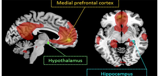 Wie Insulin im Gehirn Hunger dämpfen kann MRT-Aufnahme: Intranasales Insulin steigert nachweislich die funktionalen Verbindungen in bestimmten kognitiven Hirnregionen (Default Mode Network, DMN) sowie im Hippocampus und Hypothalamus.