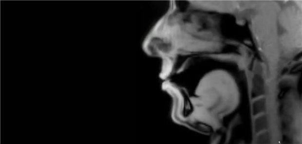 MRT-Aufnahme der inneren Sprechmuskeln eines 42-jährigen Patienten mit idiopathischem Stottern, während er einen Text vorliest.
