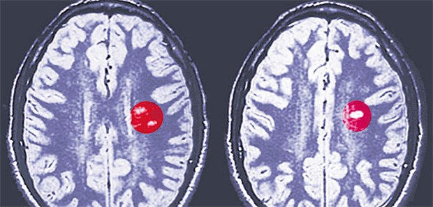 MRT-Aufnahme des Gehirns bei einem Patienten mit Multipler Sklerose. Die Herde sind umrandet.