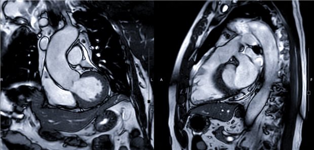 MRT-Aufnahme des Herzens