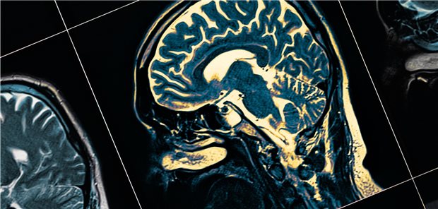 MRT-Aufnahme des Kopfes: Kommt die Agitation vielleicht von einem Hirnturmor?