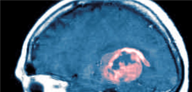 MRT-Aufnahme eines Patienten mit Glioblastom. Patienten mit Stadium IV haben noch immer eine schlechte Prognose.
