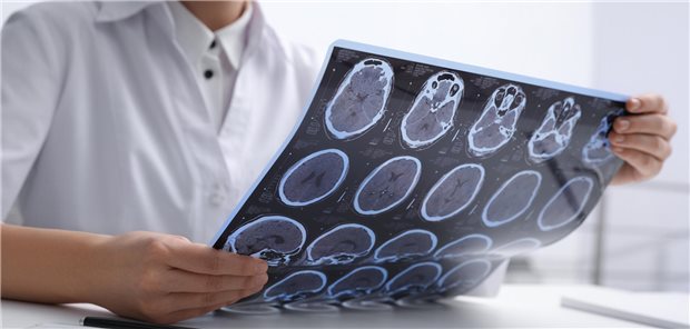 MRT-Aufnahme eines Patienten mit MS: Das IQWiG hat den Zusatznutzen von Dimethylfumarat bei Kindern und Jugendlichen mit MS untersucht.