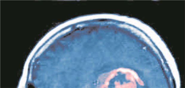 MRT-Aufnahme eines Patienten mit einem Glioblastom.