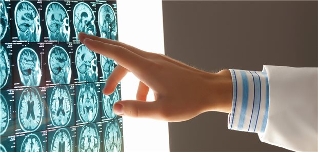 MRT-Aufnahmen mit standardisierten Sequenzen sollen nun neben einer Liquoruntersuchung zur Abklärung einer MS verwendet werden, empfiehlt die neue S2k-Leitlinie.