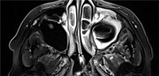 MRT-Aufnahmen vom 6. Dezember mit Befund einer Sinusitis maxillaris