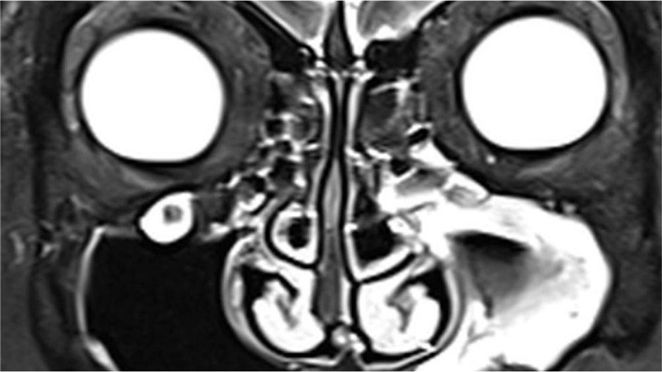 MRT-Aufnahmen vom 6. Dezember mit Befund einer Sinusitis maxillaris (Abbildungen 1, 2 und 3)