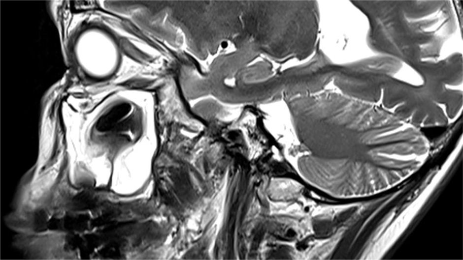 MRT-Aufnahmen vom 6. Dezember mit Befund einer Sinusitis maxillaris (Abbildungen 1, 2 und 3)