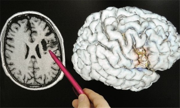 Wird Hypothermie bald Therapieoption bei Apoplexie? MRT-Bild und Gehirnmodell eines Patienten mit Schlaganfall. Erste Studien mit Hypothermie bei Apoplexie sind vielversprechend.