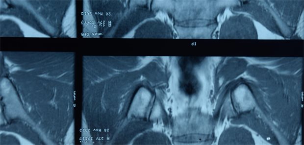 MRT-Aufnahme zur Diagnosesicherung einer axialen Spondyloarthritis.