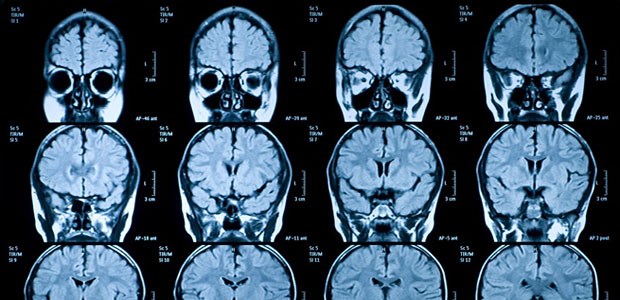 Psychopathen-Test per MRT MRT-Schichtbilder eines menschlichen Gehirns. Die Bildgebung wird zur Diagnostik bei Psychopathie geprüft.