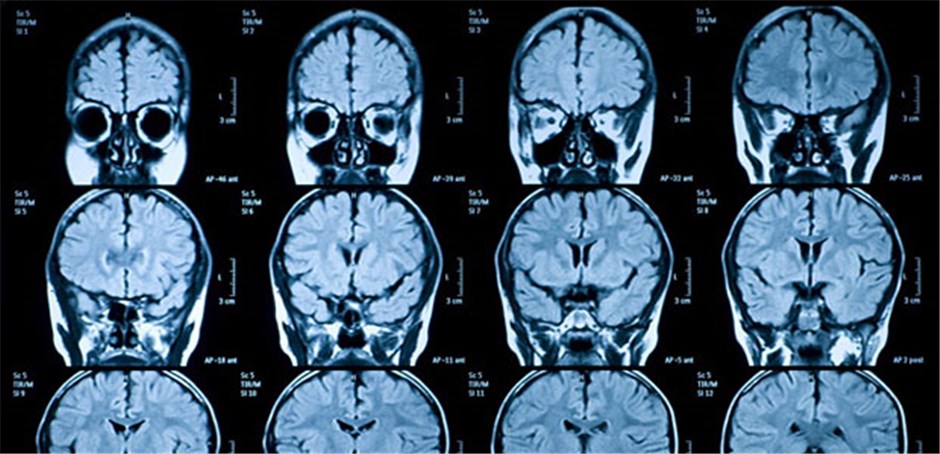 Psychische Erkrankung Im Mrt Sichtbar