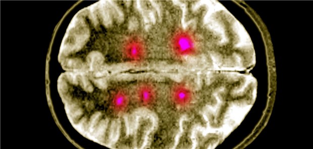 Neurofilament-Wert zeigt MS-Risiko an MRT des Gehirns mit Läsionen durch Multiple Sklerose; die Prognose bei CISPatienten lässt sich anhand des NFL beurteilen.