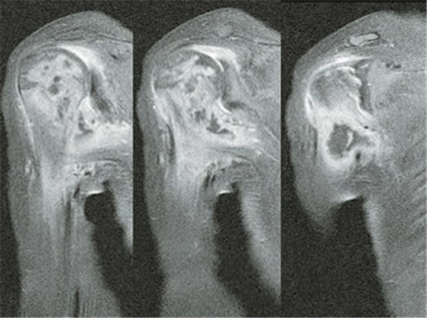 Knochentuberkulose bei einer Zweijährigen MRT rechte Schulter: pathologisch vermehrte Kontrastmittelanreicherung des proximalen Humerus mit mehreren intraossären Einschmelzungen und Abszessbildung medianseits. © www.springeronline.com