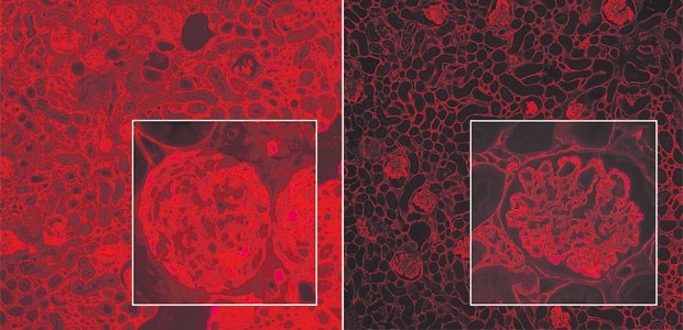 ACE-Hemmer bewahrt junge Patienten vor der Dialyse Mäusemodell: In der Immunfluoreszenz zeigen unbehandelte Tiere mit Alport-Syndrom eine stark erhöhte Einlagerung von Bindegewebe in die Glomeruli (li. Bild). Bei Mäusen, denen täglich ACE-Hemmer mit dem Trinkwasser verabreicht wurden, sind die krankhaften Einlagerungen deutlich geringer (re. Bild).