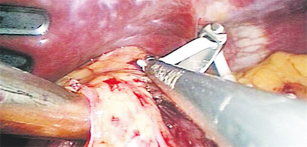 Das Messer allein ist nicht die Lösung Magenband und Portimplantation - die gesetzliche Krankenversicherung übernimmt die Kosten nur im Einzelfall.