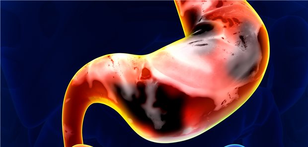 Magenkarzinom: Bei Asiaten konnte mit dem PD-1-Antikörper Nivolumab das progressionsfreie Überleben verbessert werden.