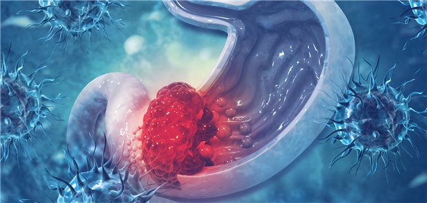 Magenkarzinom: Minimalinvasive oder offene Operation?&#xA;