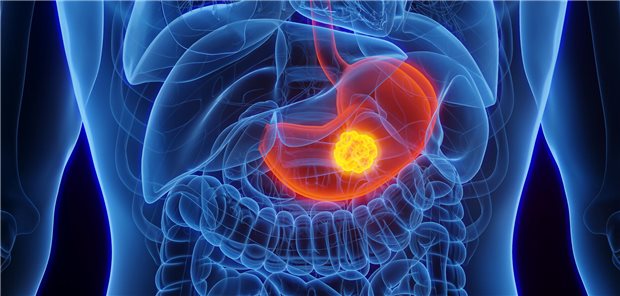 Magenkrebs (Symbolbild).