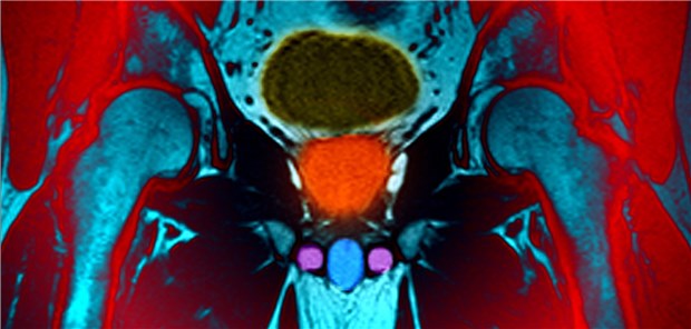 Magnetresonanz-Aufnahme des männlichen Beckens: Die Prostata ist orange eingefärbt.