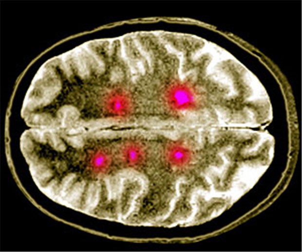 Geheimnis um Multiple Sklerose gelüftet? Magnetresonanztomografische Aufnahme des Gehirns mit Läsionen durch Multiple Sklerose.