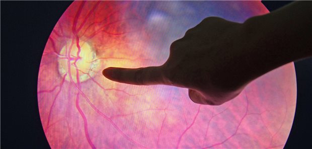 Makulaödem: Empfohlen wird eine Therapie mit intravitrealen VEGFInhibitoren.